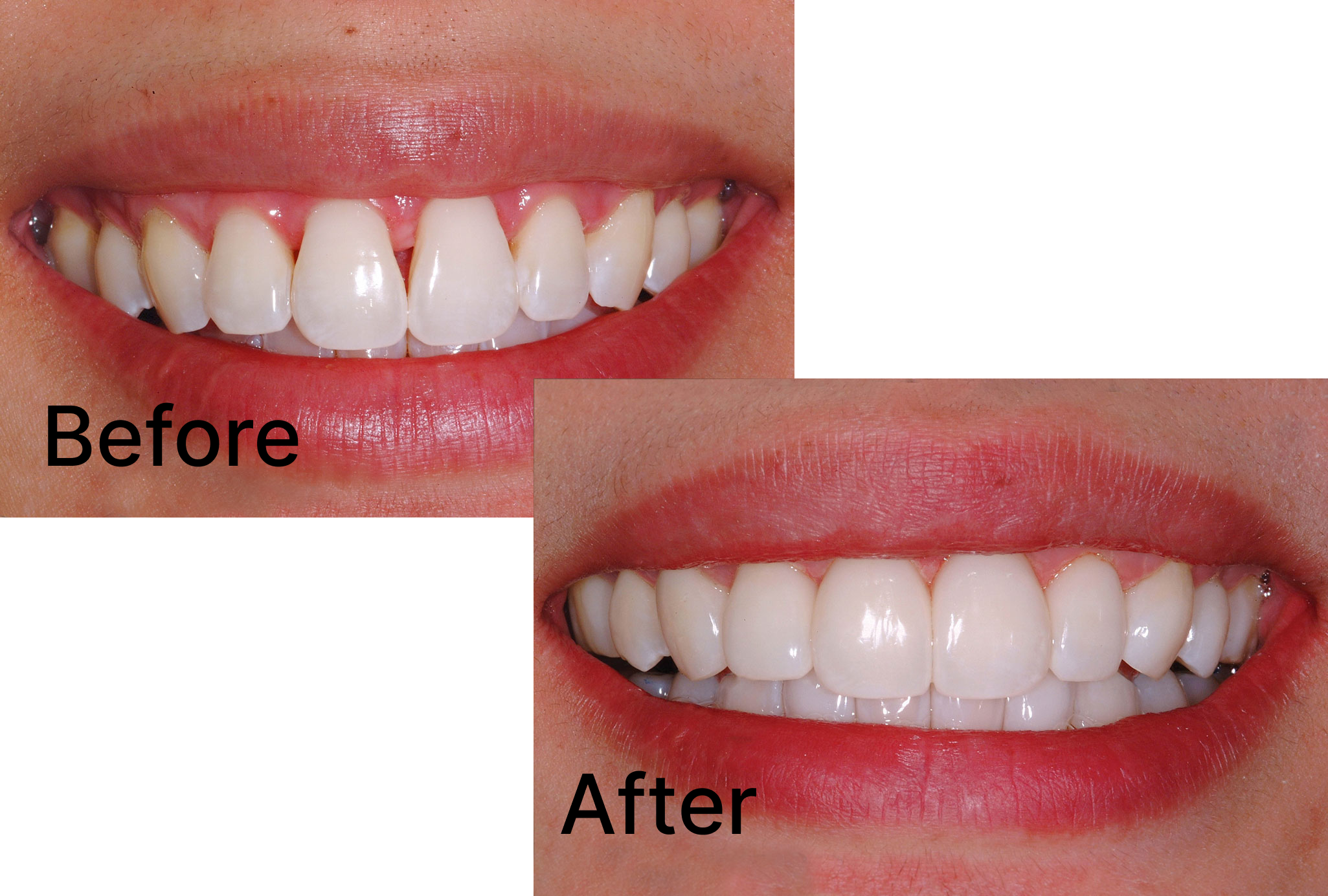 Do you dislike your front teeth but are hesitant to get veneers because of the cost?